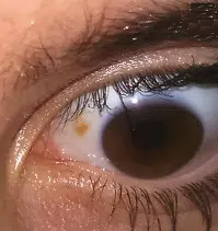 žuta mrlja na bjeloočnici