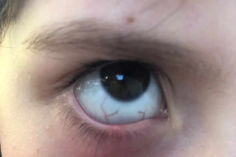 Gnojna točkica na kapku