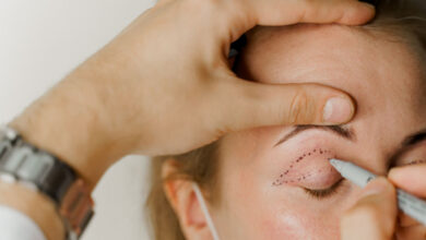 Blefaroplastika