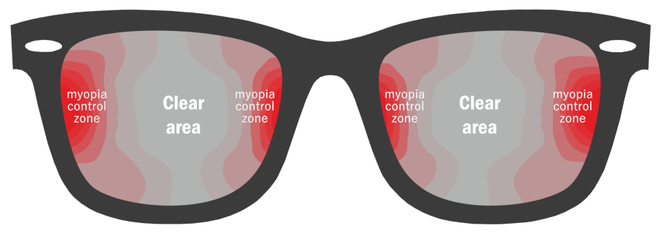 Myo kids naočalne leće