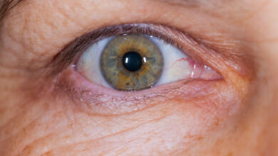 Žuta pjega Optical Express