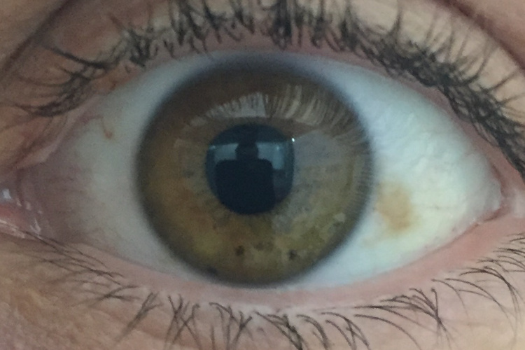 Mrlja na oku