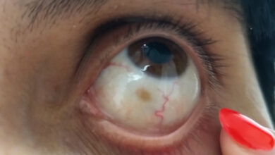 Smeđa mrlja na bjeloočnici