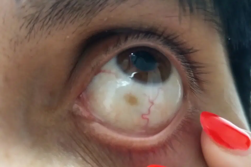 Smeđa mrlja na bjeloočnici